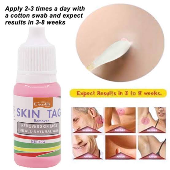 Skin Tag Removal